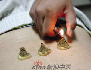 灸法的種類  你知道多少？